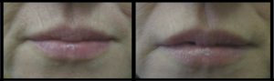 Before and After Lip Rejuvenation by Dr Teri Johnson Dr Teri Johnson Middlewich Cheshire