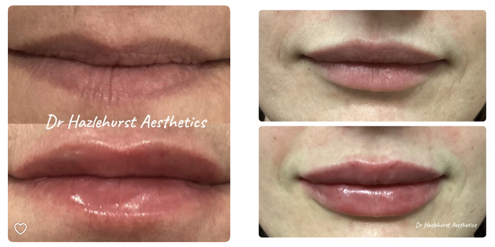 lip filler by dr Kathryn Hazlehurst