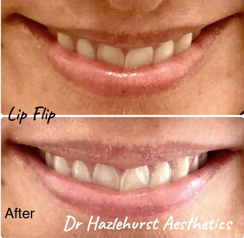 lip flip Botox dr Kathryn Hazlehurst
