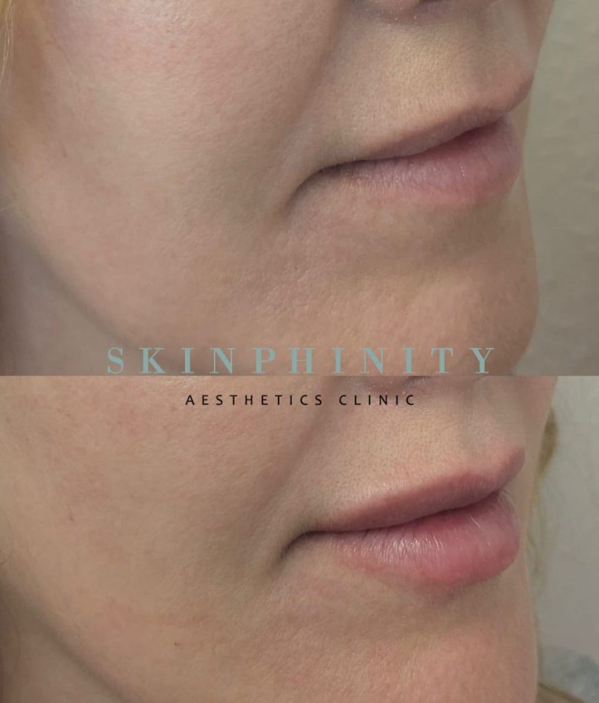 before and after dermal filler to enhance the lips