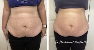Aqualyx before and after photo 2 treatments. Dr Hazlehurst Cheshire