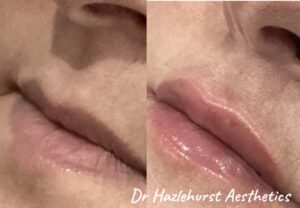 Stylage lip treatment dr Hazlehurst