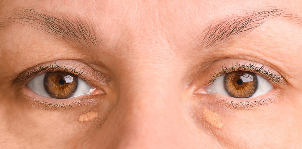 xanthelasma removal cheshire,Cholesterol