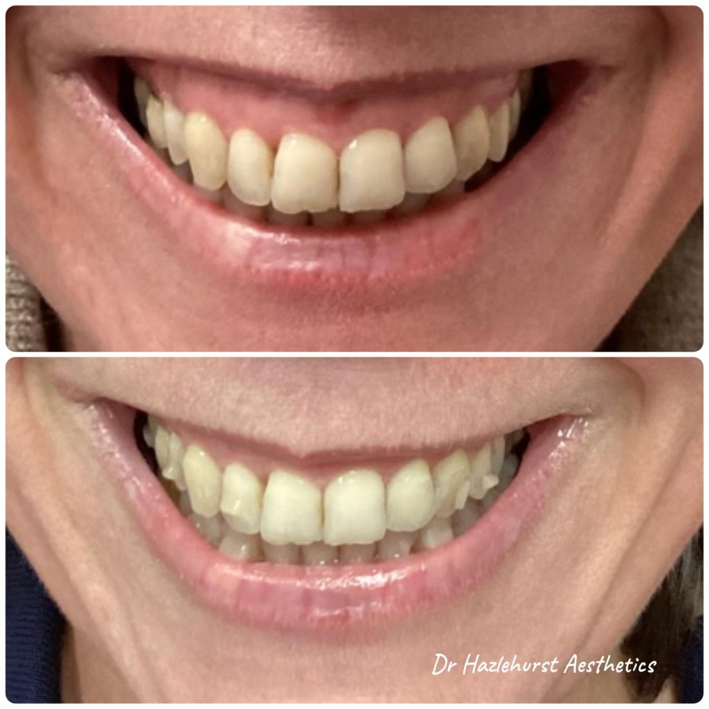 Botox Gummy smile treatment br Dr Kathryn Hazlehurst