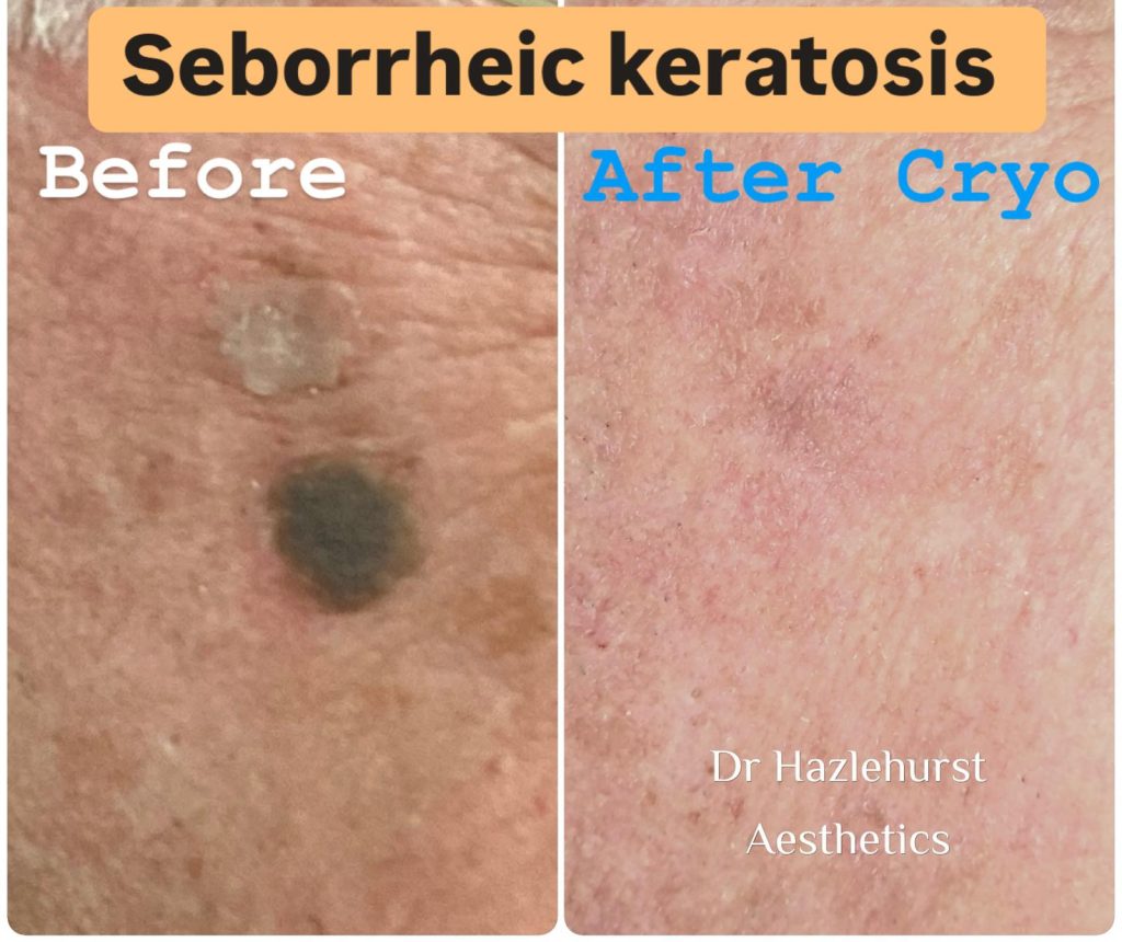 Before and after Cryotherapy to seborrheic keratosis with Dr Hazlehurst